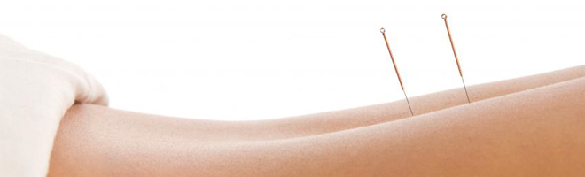 Therapieverfahren: Klassische Akupunktur