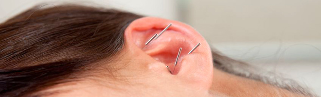 Therapieverfahren: Ohrakupunktur